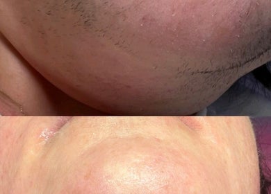 Before and after laser treatment at Ep Laser Clinic Shrewsbury, Shrewsbury, England, GB.
