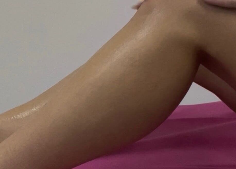Leg treatment at Ep Laser Clinic Shrewsbury, England, GB, showcasing smooth skin results.