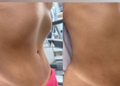 Resultados de tratamento corporal em AnaMar Beauty, Gold Coast, Queensland, AU, mostrando antes e depois.