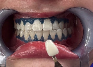 Teeth whitening process at The Derma Clinic Cheshire, Hyde, England, GB. Enhancing smiles with precision.