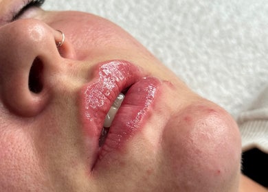 Glossy lips treatment at The Derma Clinic Cheshire, Hyde, England, GB creates a smooth shine.