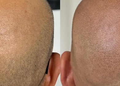 Résultats de micropigmentation capillaire à Soum SMP, El Achour, Algiers Province, DZ.
