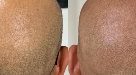 Résultats de micropigmentation capillaire à Soum SMP, El Achour, Algiers Province, DZ.