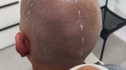 Micropigmentation capillaire à Soum SMP, El Achour, Algiers Province, DZ, offrant une finition soignée et précise.