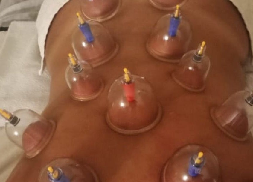 Sessão de ventosaterapia em Litoral Pés Podologia Integrada, Bahia, Bahia, BR. Técnica de alívio e relaxamento.