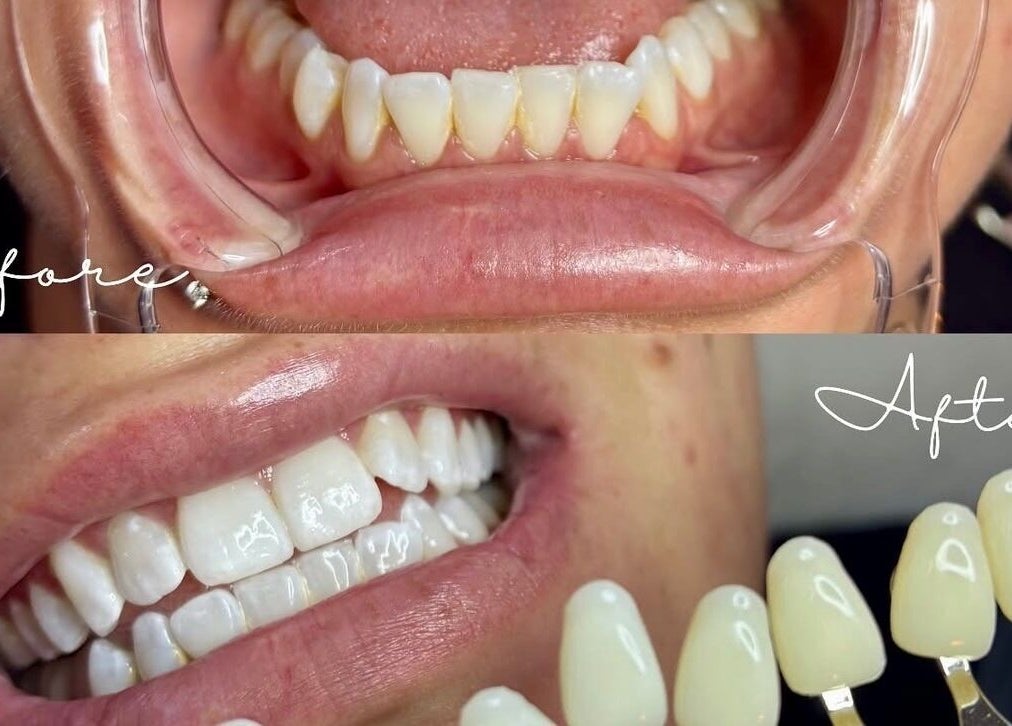 Before and after teeth whitening at The Lash Bar, Edmonton, Alberta, CA showing dramatic transformation.