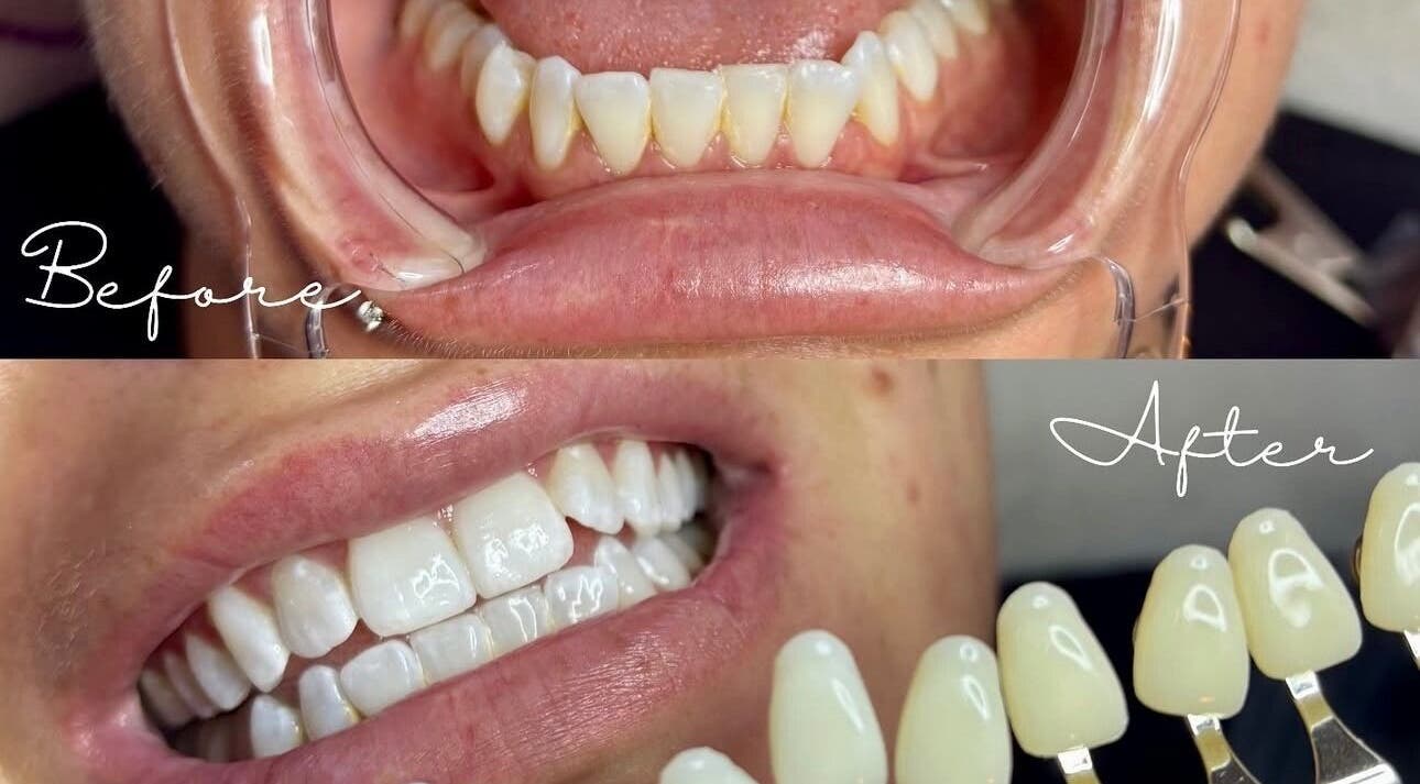 Before and after teeth whitening at The Lash Bar, Edmonton, Alberta, CA showing dramatic transformation.
