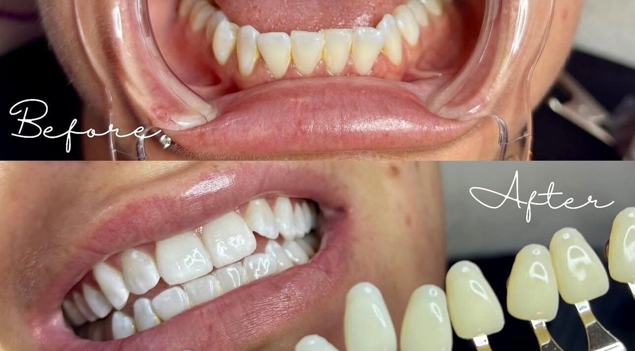 Before and after teeth whitening at The Lash Bar, Edmonton, Alberta, CA showing dramatic transformation.