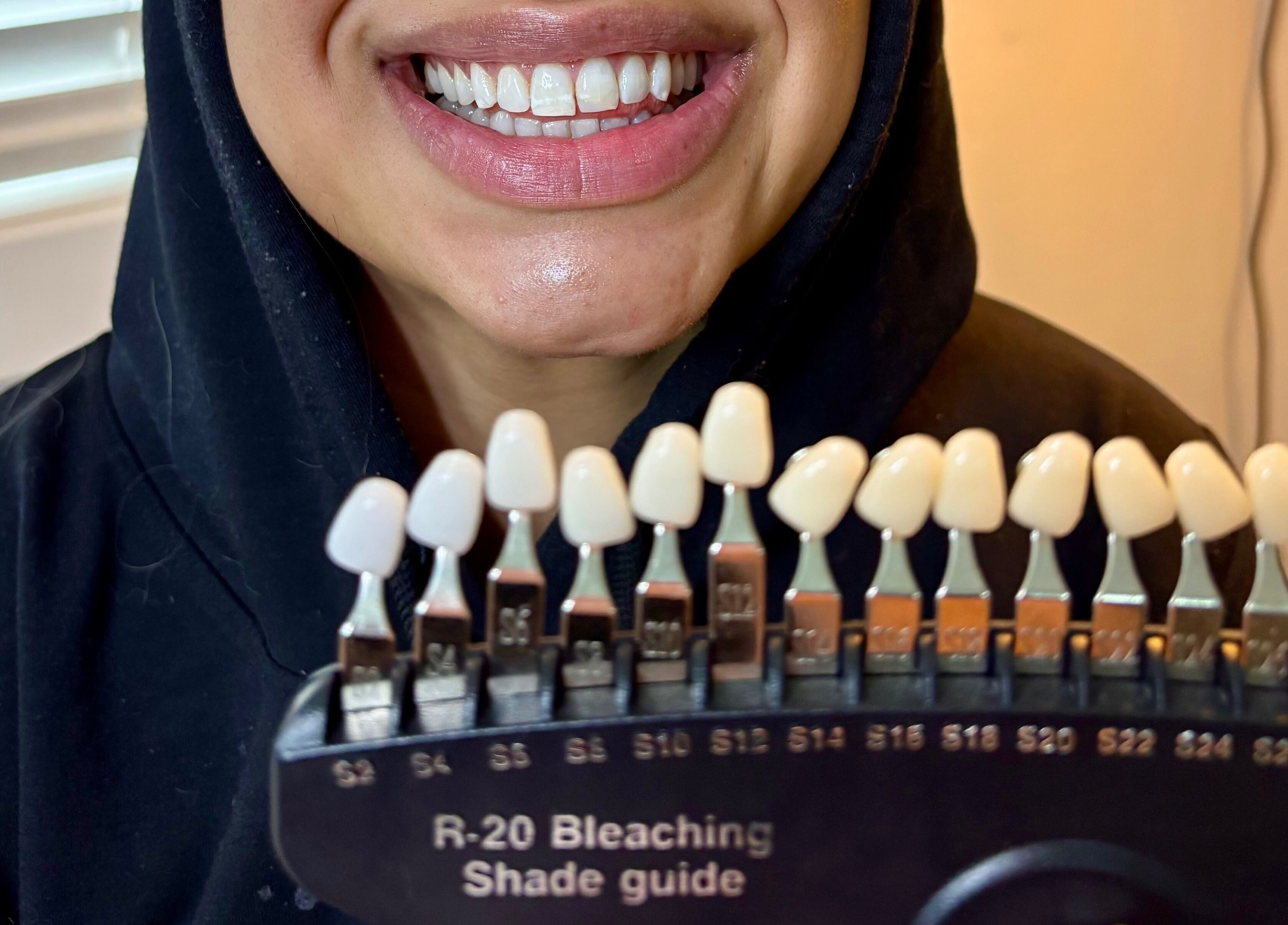 Teeth shade guide displayed at The Lash Bar, Edmonton, Alberta, CA, showcasing diverse whitening options.