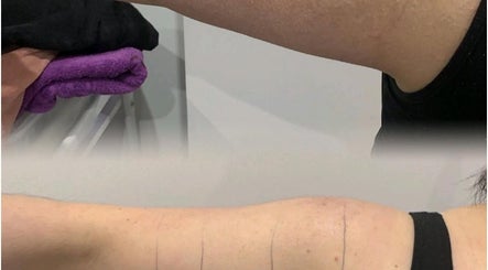 Arm treatment at Ains Beauty and Advanced Aesthetics, Reigate, England, GB showing before and after results.
