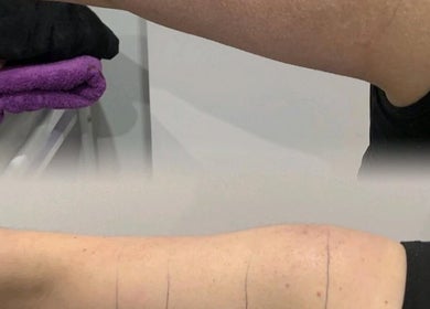 Arm skin treatment at Ains Beauty and Advanced Aesthetics, Reigate, England, GB. Enjoy flawless skin results.