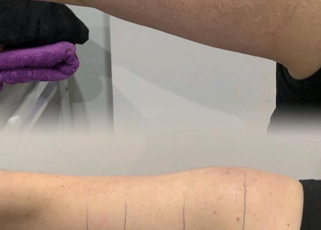 Arm skin treatment at Ains Beauty and Advanced Aesthetics, Reigate, England, GB. Enjoy flawless skin results.