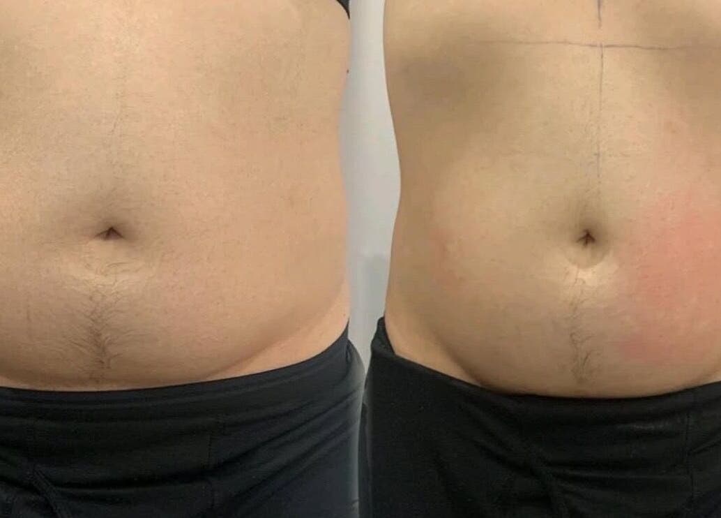 Body contouring results at Ains Beauty and Advanced Aesthetics, Reigate, England, GB showcasing a before and after.