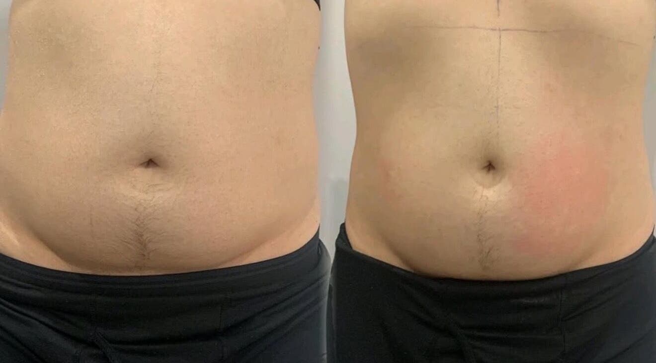 Body contouring results at Ains Beauty and Advanced Aesthetics, Reigate, England, GB showcasing a before and after.