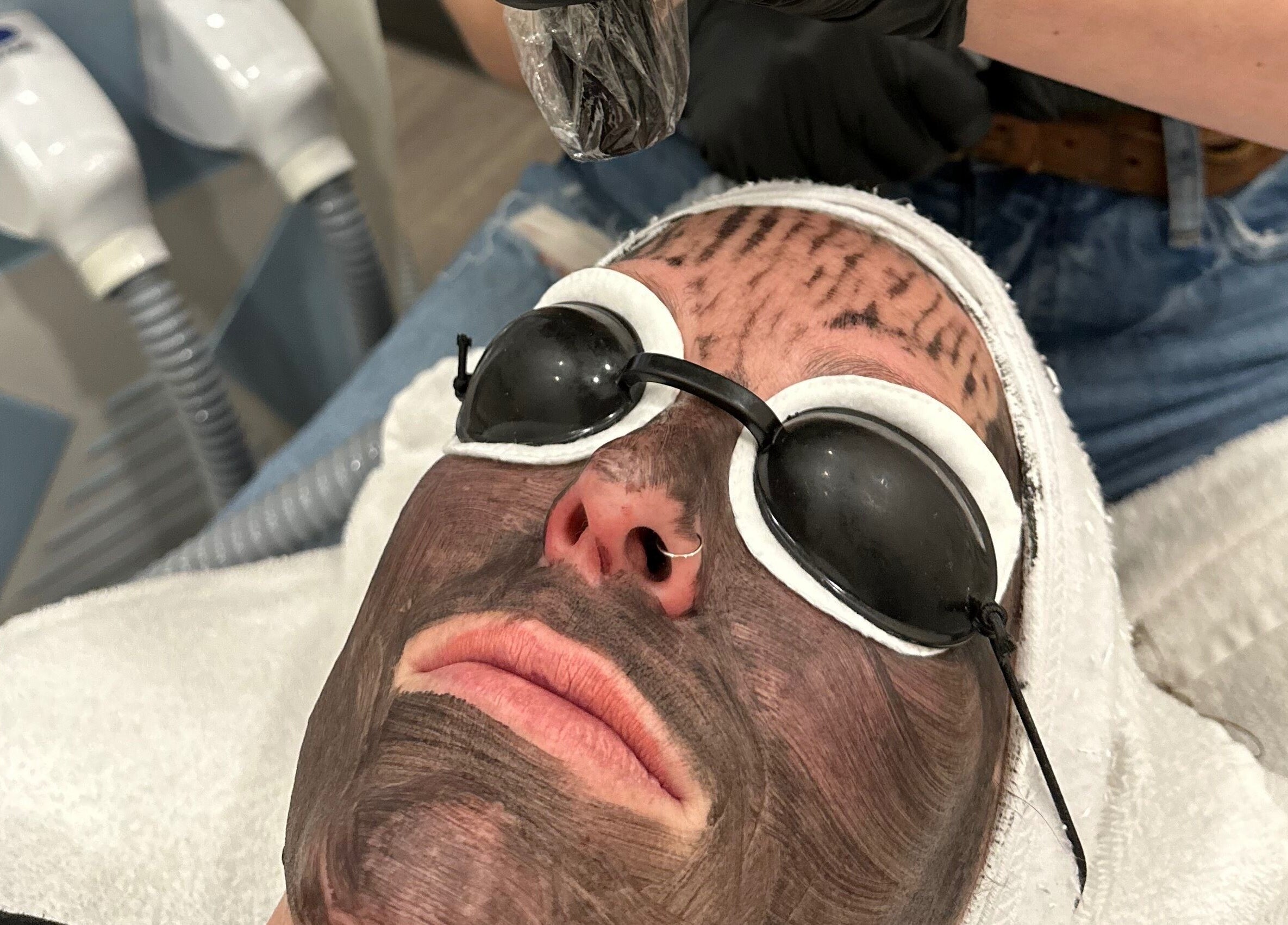 Laser facial treatment at Skin Deep Medical Aesthetics in Carlyle, Saskatchewan, CA for radiant skin.