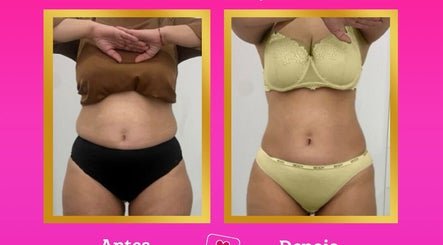 Resultados de tratamento na Estética Tatiane Martins, Lisboa, Lisboa, PT. Imagem antes e depois de clienta.
