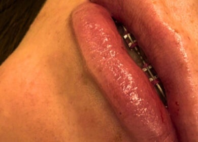 Lush lip enhancement at CMA GLAM&TAN, Chadderton, England, GB showcasing expert beauty treatment.