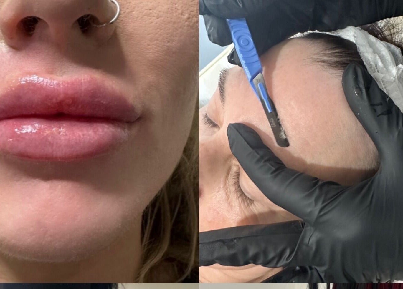 Dermaplaning and lip enhancement at Pretty Perfect Purbrook, Waterlooville, England, GB.