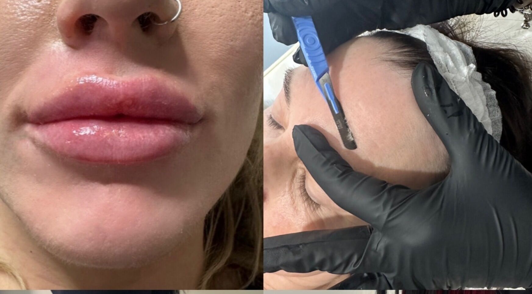 Dermaplaning and lip enhancement at Pretty Perfect Purbrook, Waterlooville, England, GB.