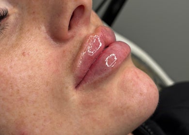 Lip enhancement at LJT Aesthetics, Herne Bay, England, showcasing glossy, well-defined lips.