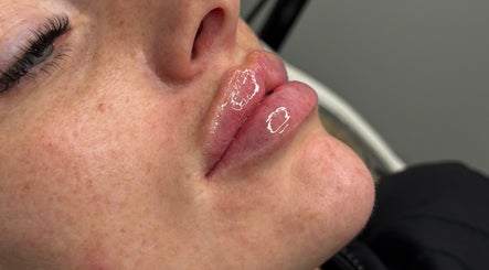Lip enhancement at LJT Aesthetics, Herne Bay, England, showcasing glossy, well-defined lips.