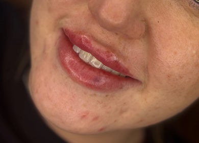 Close-up of glossy lips treated at LJT Aesthetics, Herne Bay, England, GB, showcasing their beauty services.