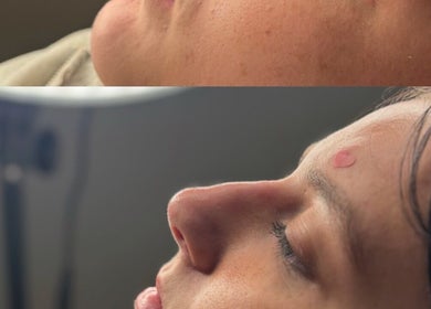 Before and after facial treatment at LJT Aesthetics, Herne Bay, England, GB showing smoother skin results.