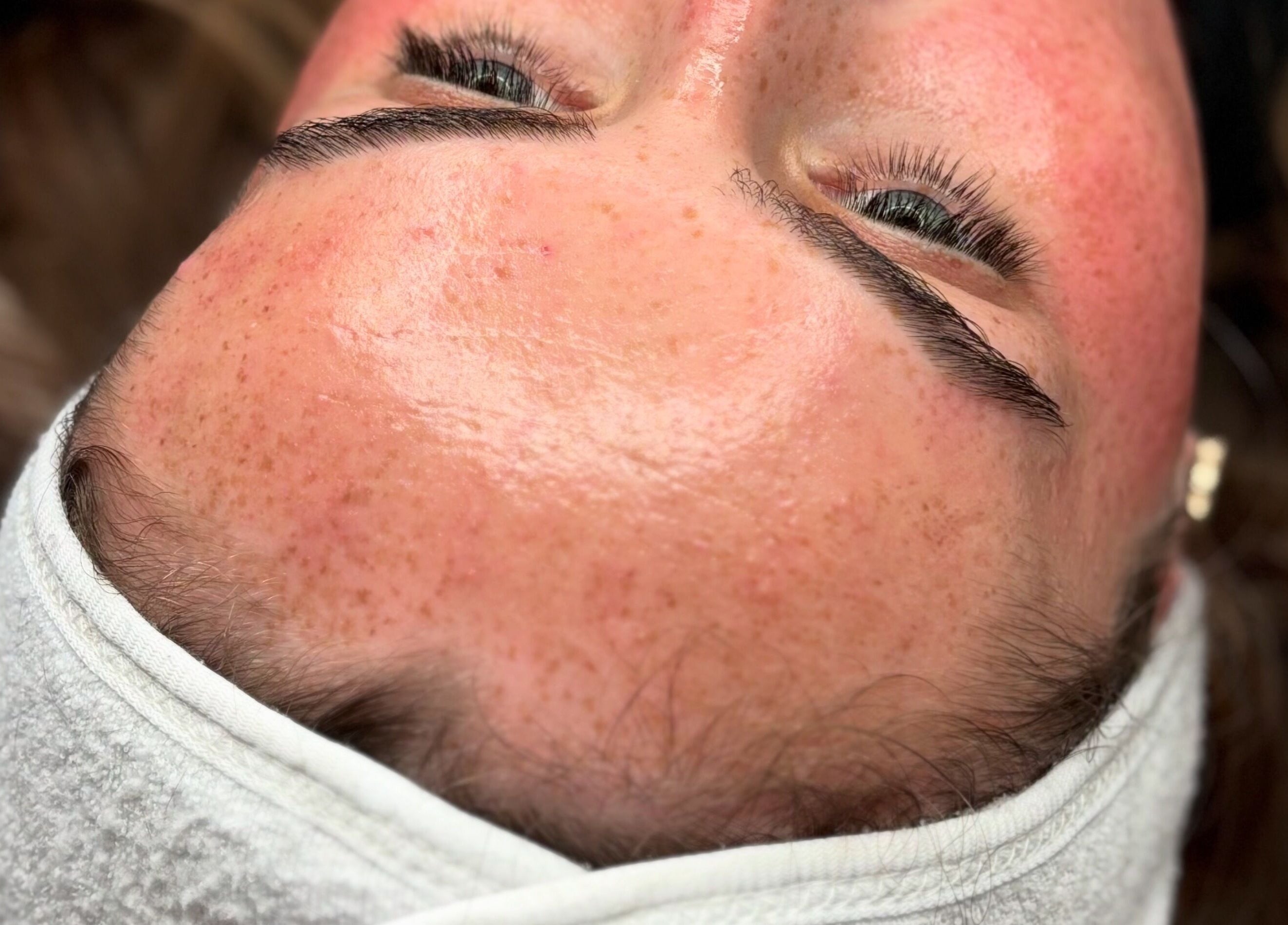 Close-up of a fresh facial treatment at Megan Bond Aesthetics, Astley Cross, England, GB.