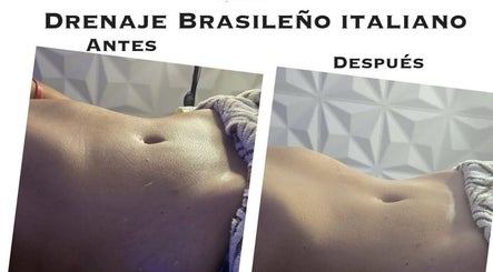 Resultados de drenaje linfático brasileño en Allesthetic by Lisandra, San Juan, San Juan, PR.