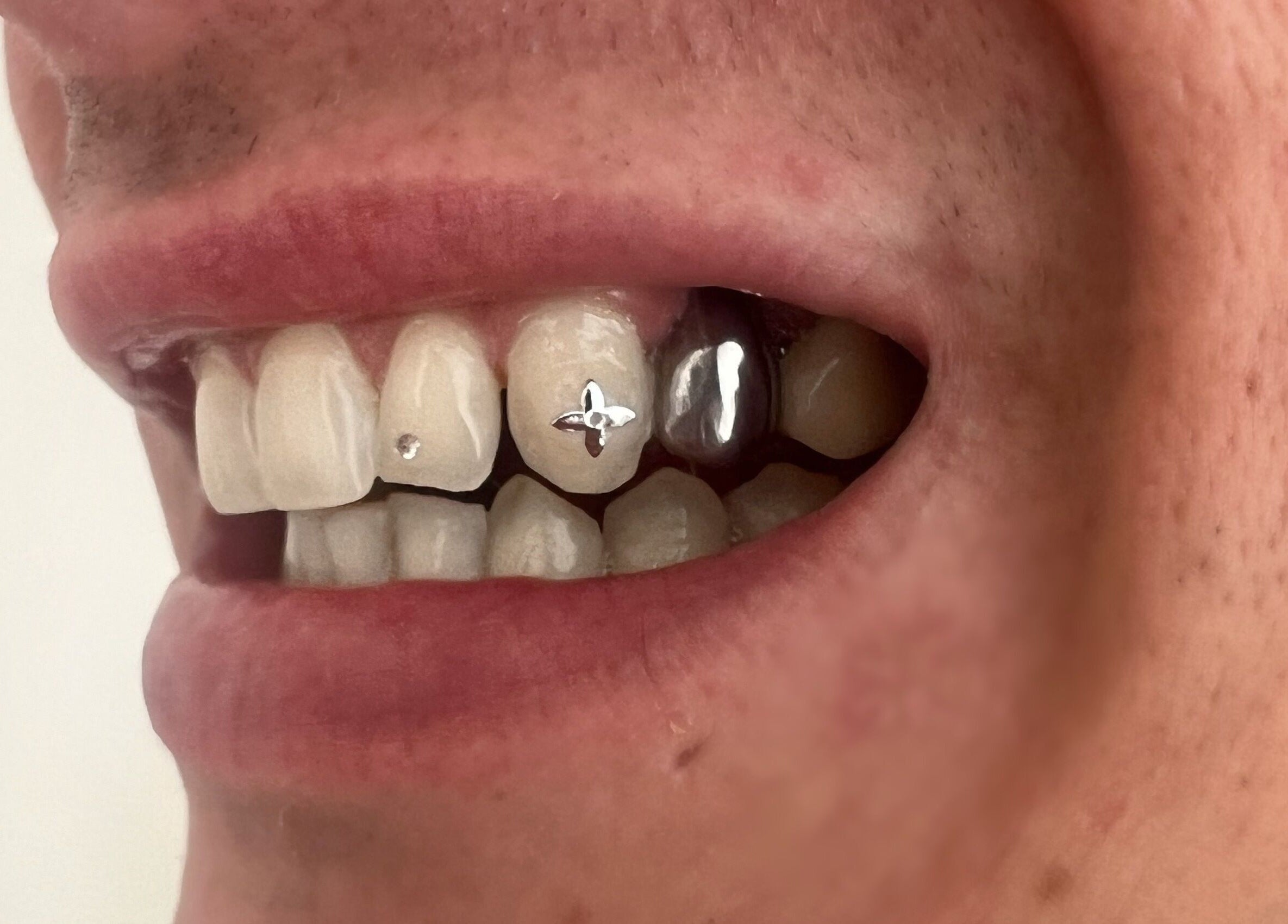 Tooth gems from Byron Bay Tooth Gems and Whitening, Byron Bay, New South Wales, AU, showcasing unique dental art.