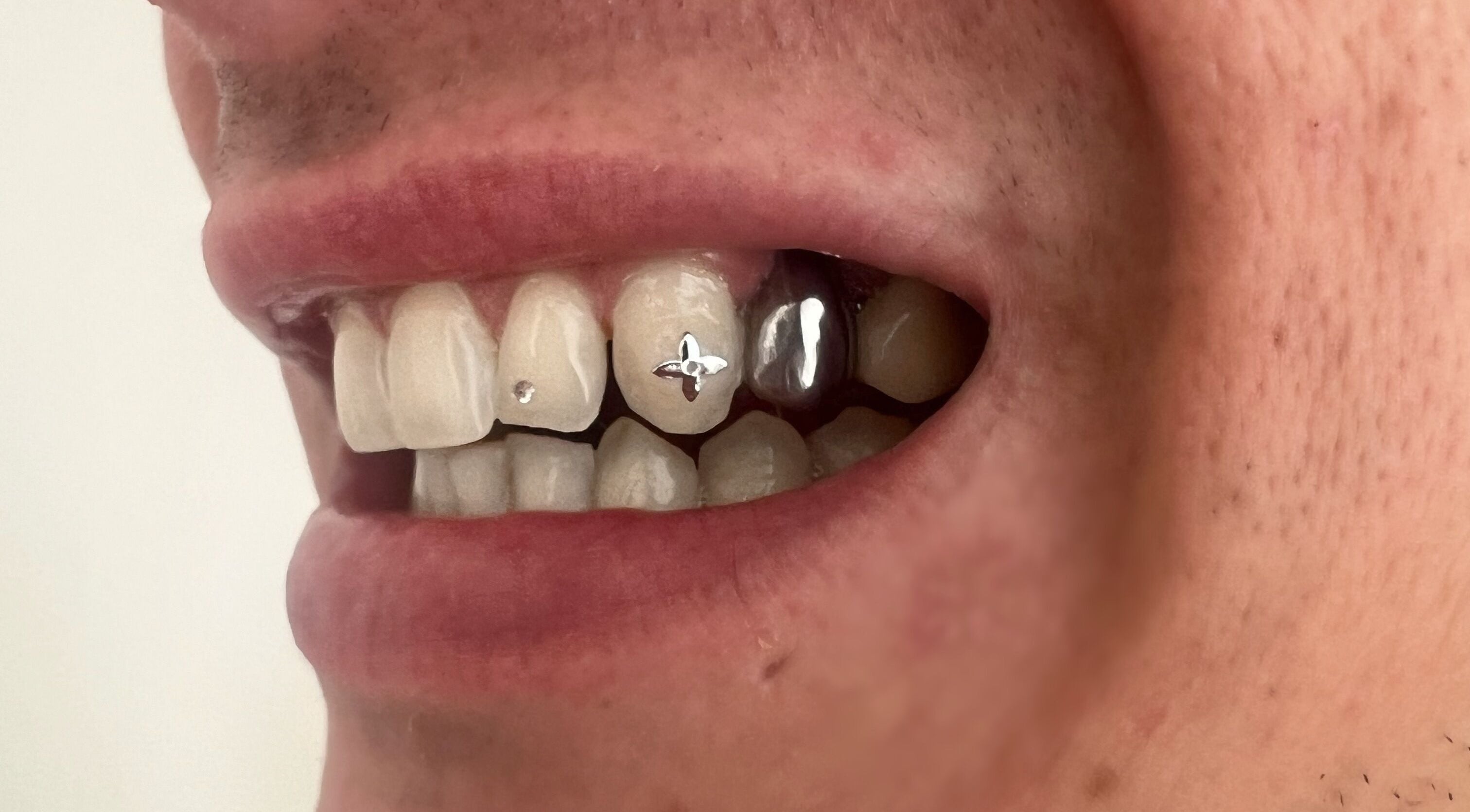 Tooth gems from Byron Bay Tooth Gems and Whitening, Byron Bay, New South Wales, AU, showcasing unique dental art.