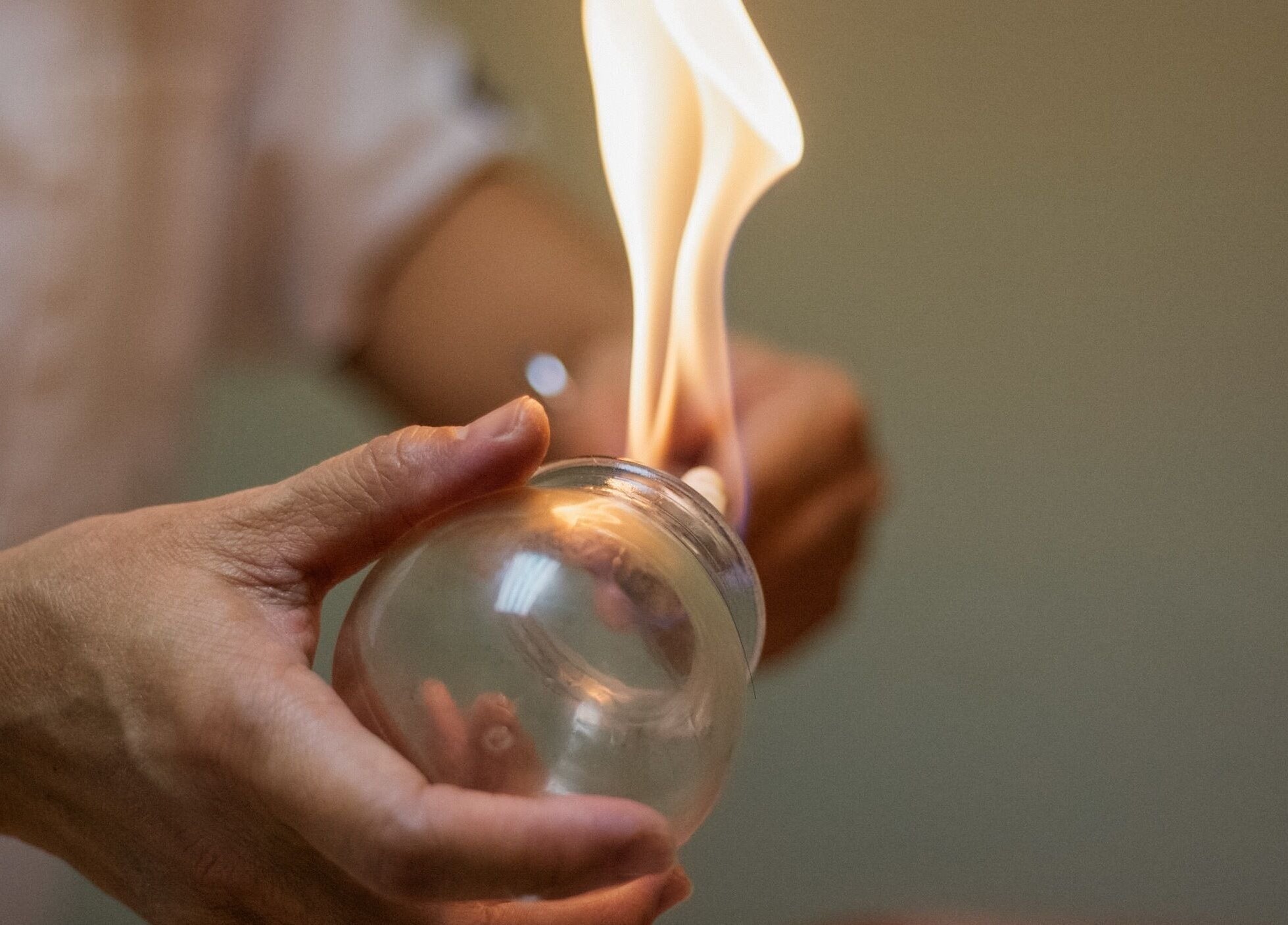 Cupping therapy at Complementary Health in Balmedie, Scotland, GB showcasing a traditional flame technique.