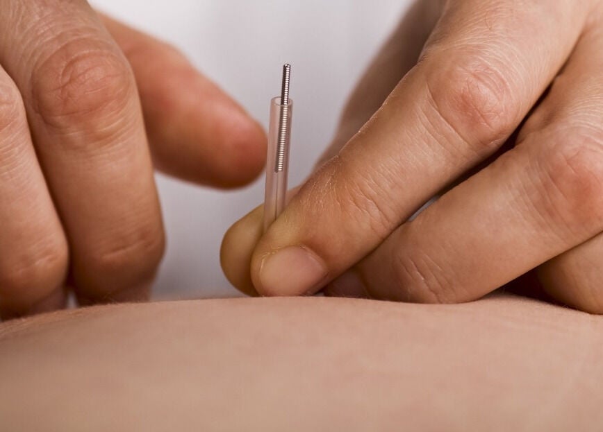Acupuncture treatment at Complementary Health in Balmedie, Scotland, GB for relaxation and wellness.