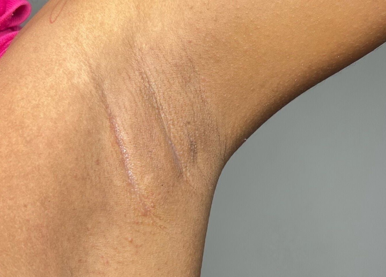 Smooth underarm texture post-treatment at The Sugar and Skin Lab, Oistins, Christ Church, BB.