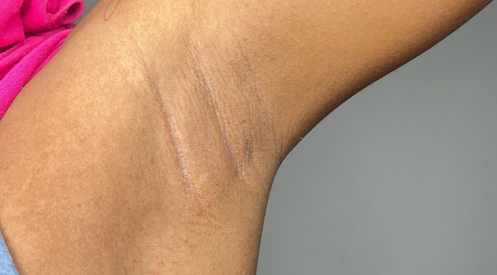 Smooth underarm texture post-treatment at The Sugar and Skin Lab, Oistins, Christ Church, BB.