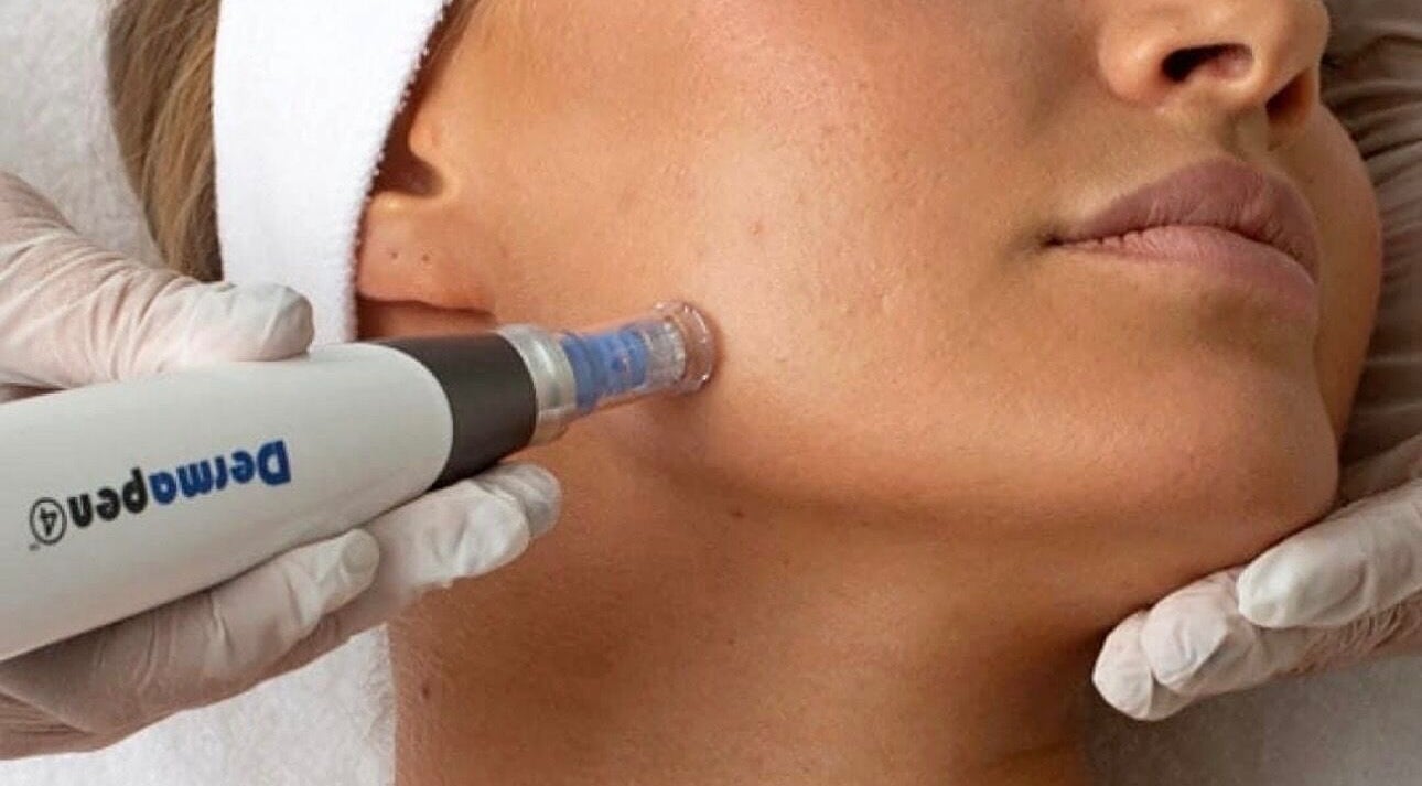 Dermapen facial treatment at The SKIN & CO., Guildford West, New South Wales, AU enhances skin radiance.
