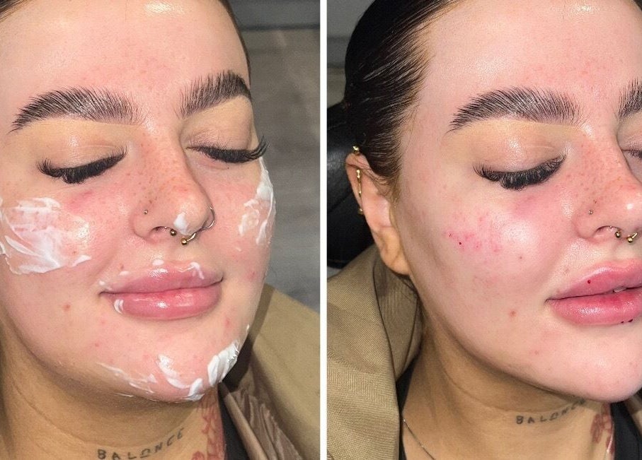 Before and after skincare treatment at Aesthetics by Gemxx in Oldham, England, GB showcasing radiant skin improvement.