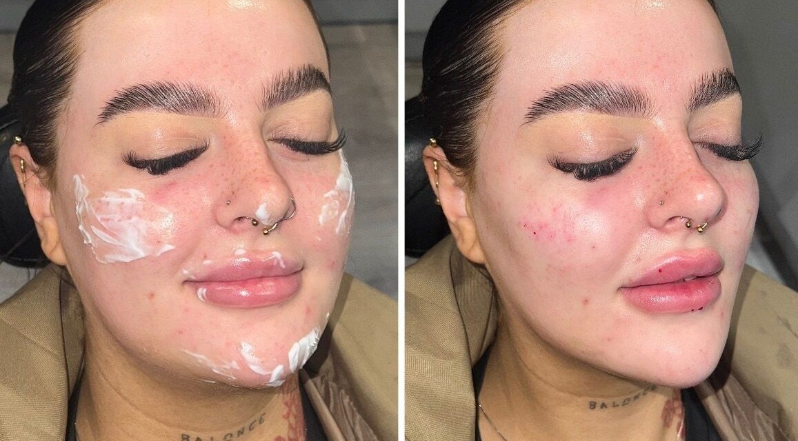 Before and after skincare treatment at Aesthetics by Gemxx in Oldham, England, GB showcasing radiant skin improvement.