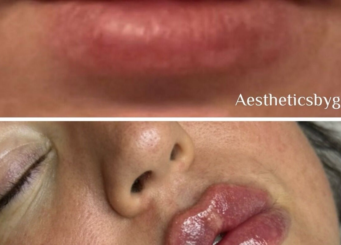 Close-up of lip enhancement at Aesthetics by Gemxx, Oldham, England, GB showcasing before and after results.