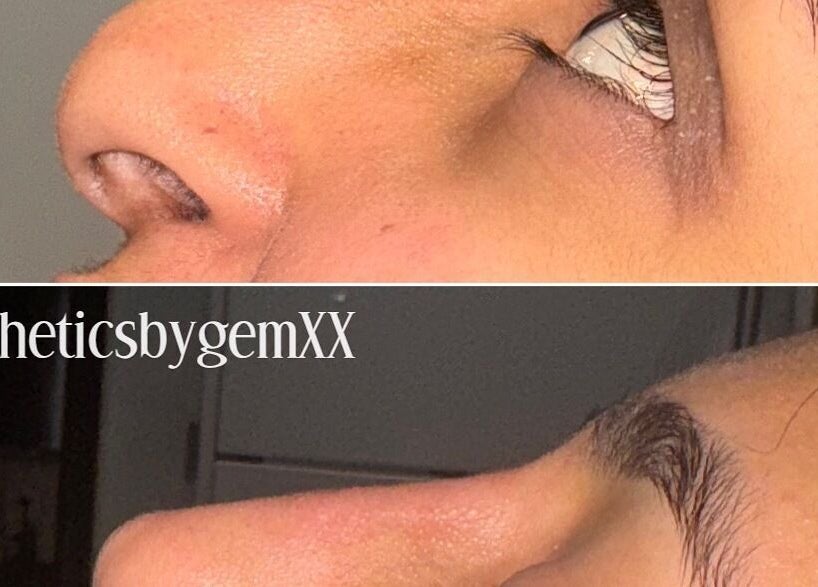 Before and after comparison of nose job at Aesthetics by Gemxx, Oldham, England, GB.