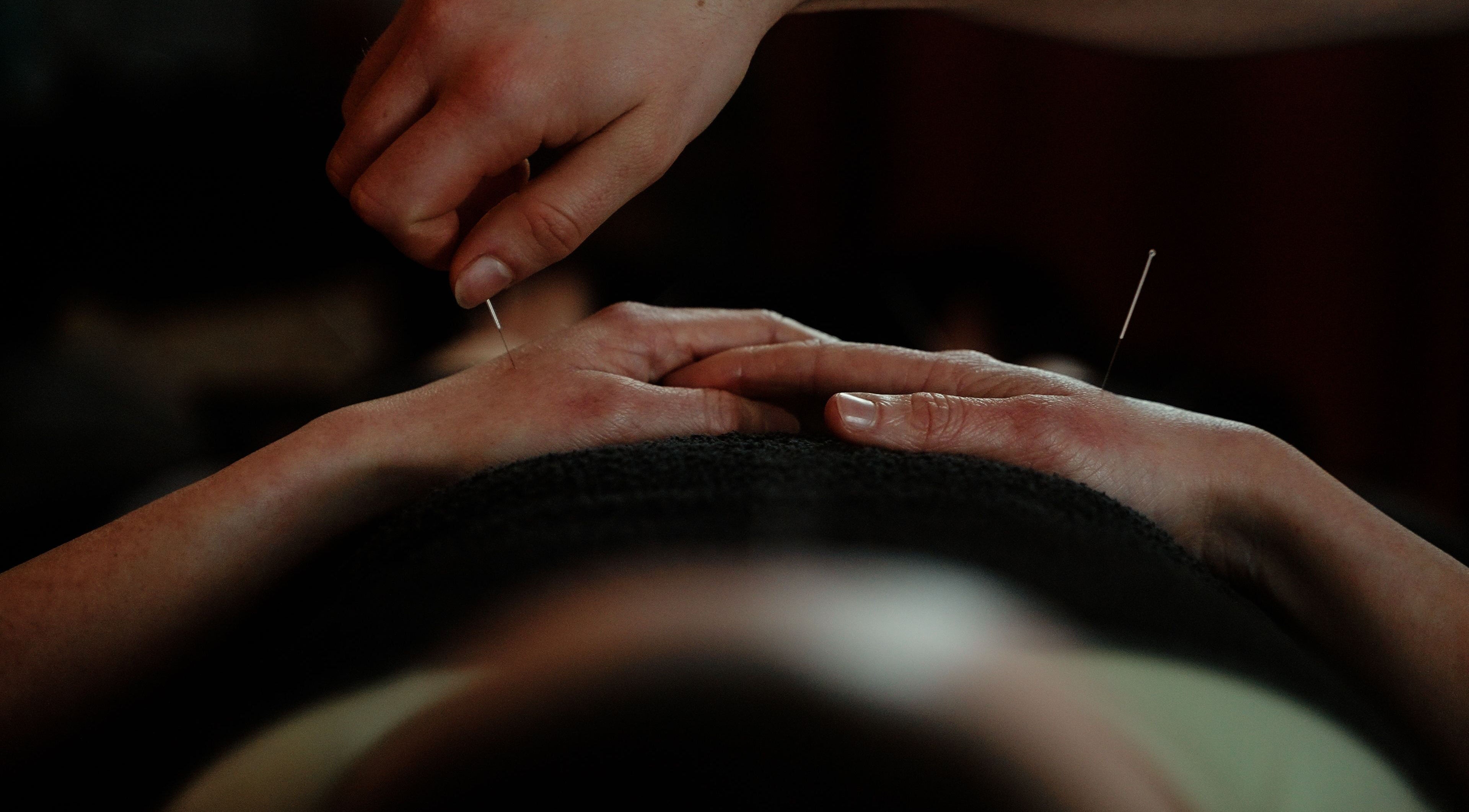 UpSamDown acupuncture therapy in Burtonwood, England, GB, showcasing hands applying treatment.