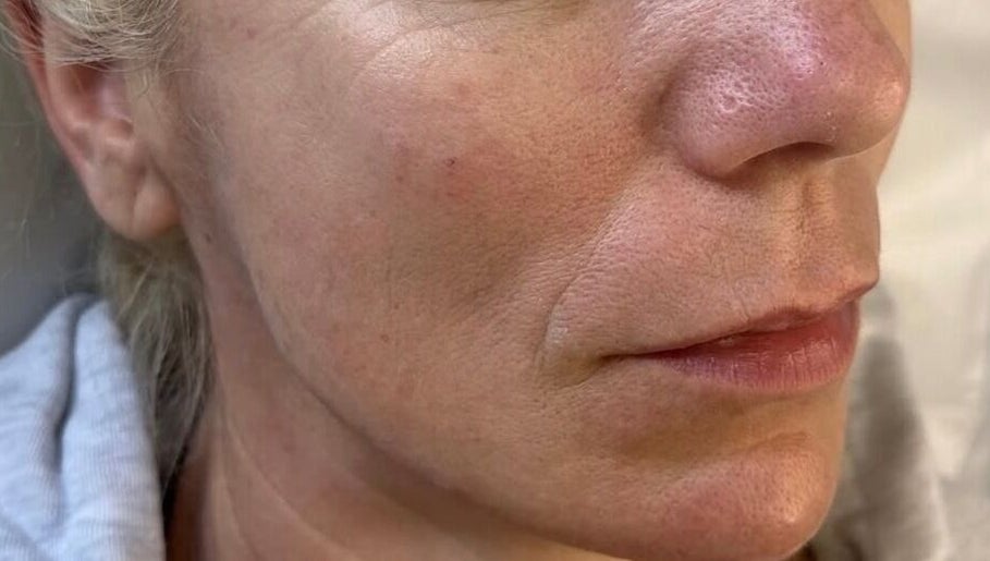 Close-up of refreshed skin at The Skin Sanctuary, Limerick, County Limerick, IE.