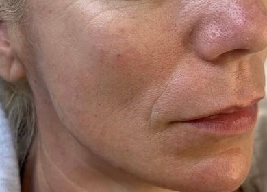 Close-up of refreshed skin at The Skin Sanctuary, Limerick, County Limerick, IE.