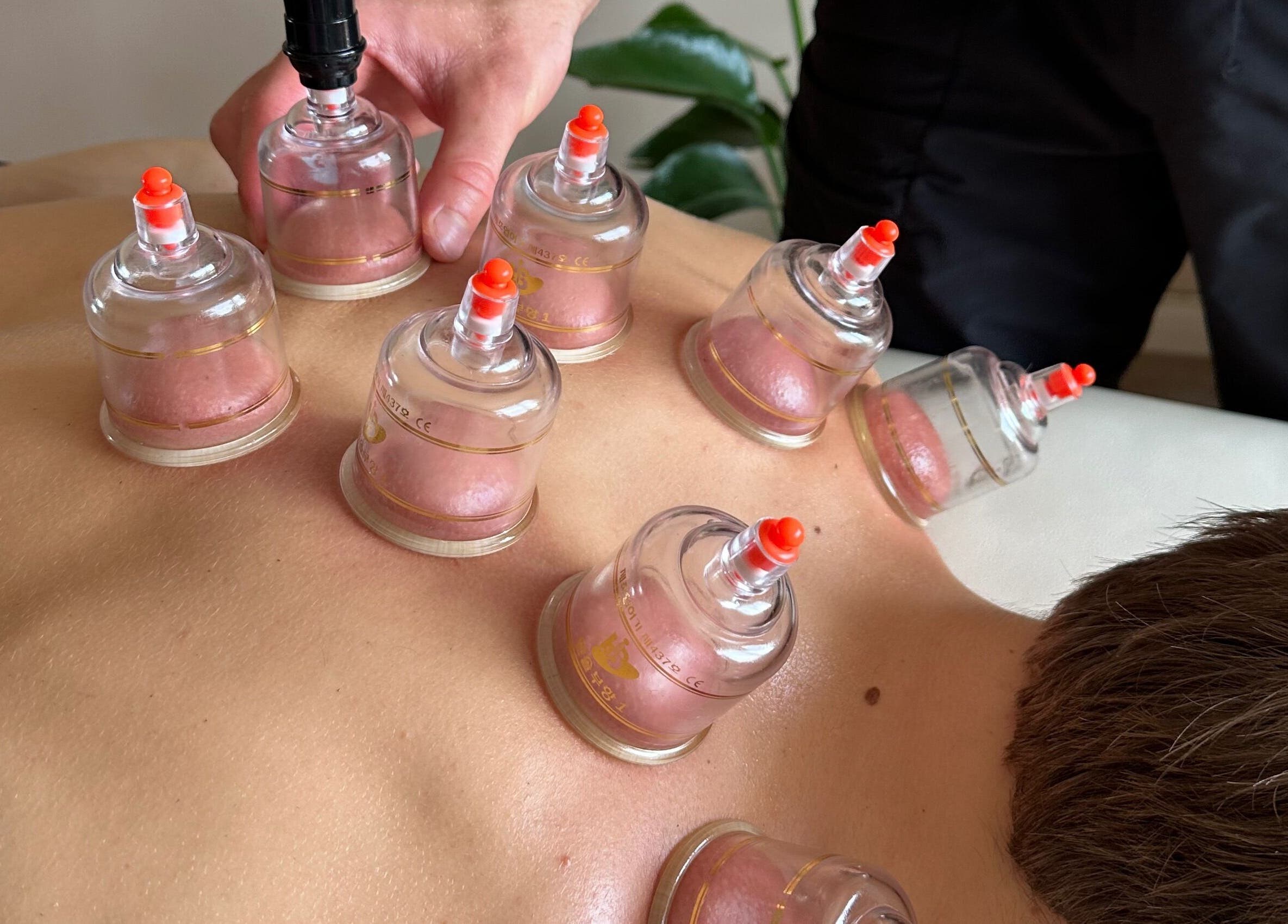Cupping therapy at Resolve Massage, Bournemouth, England, GB, enhancing relaxation and wellness with skilled techniques.