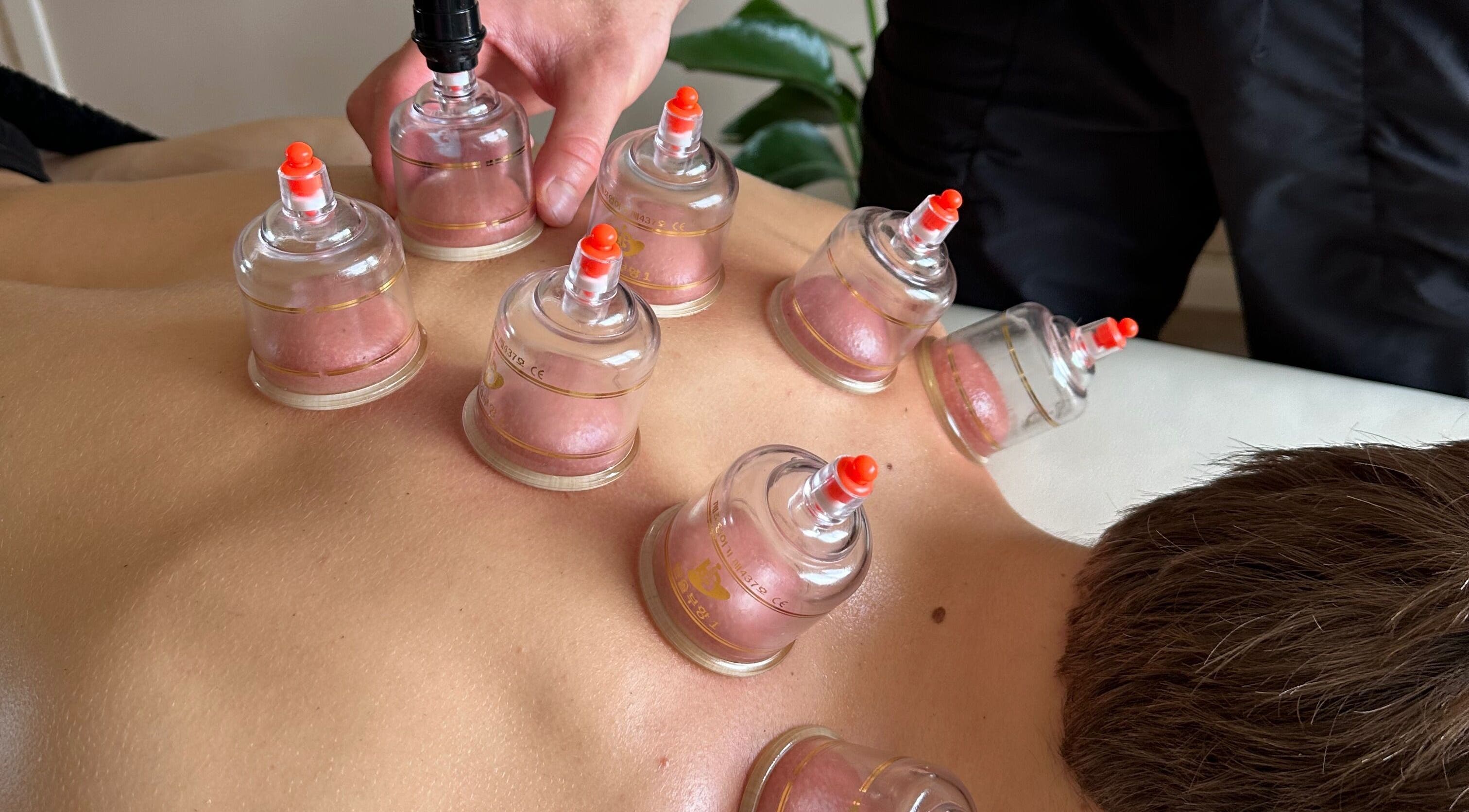 Cupping therapy at Resolve Massage, Bournemouth, England, GB, enhancing relaxation and wellness with skilled techniques.