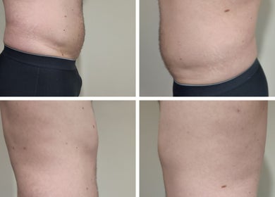 Before and after body contouring at Elevation Body Boost, Vancouver, British Columbia, CA.