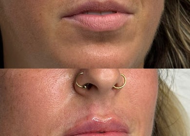 Lip enhancement at Reify Aesthetics, Chorley, England. Transformative results shown in before-and-after photos.