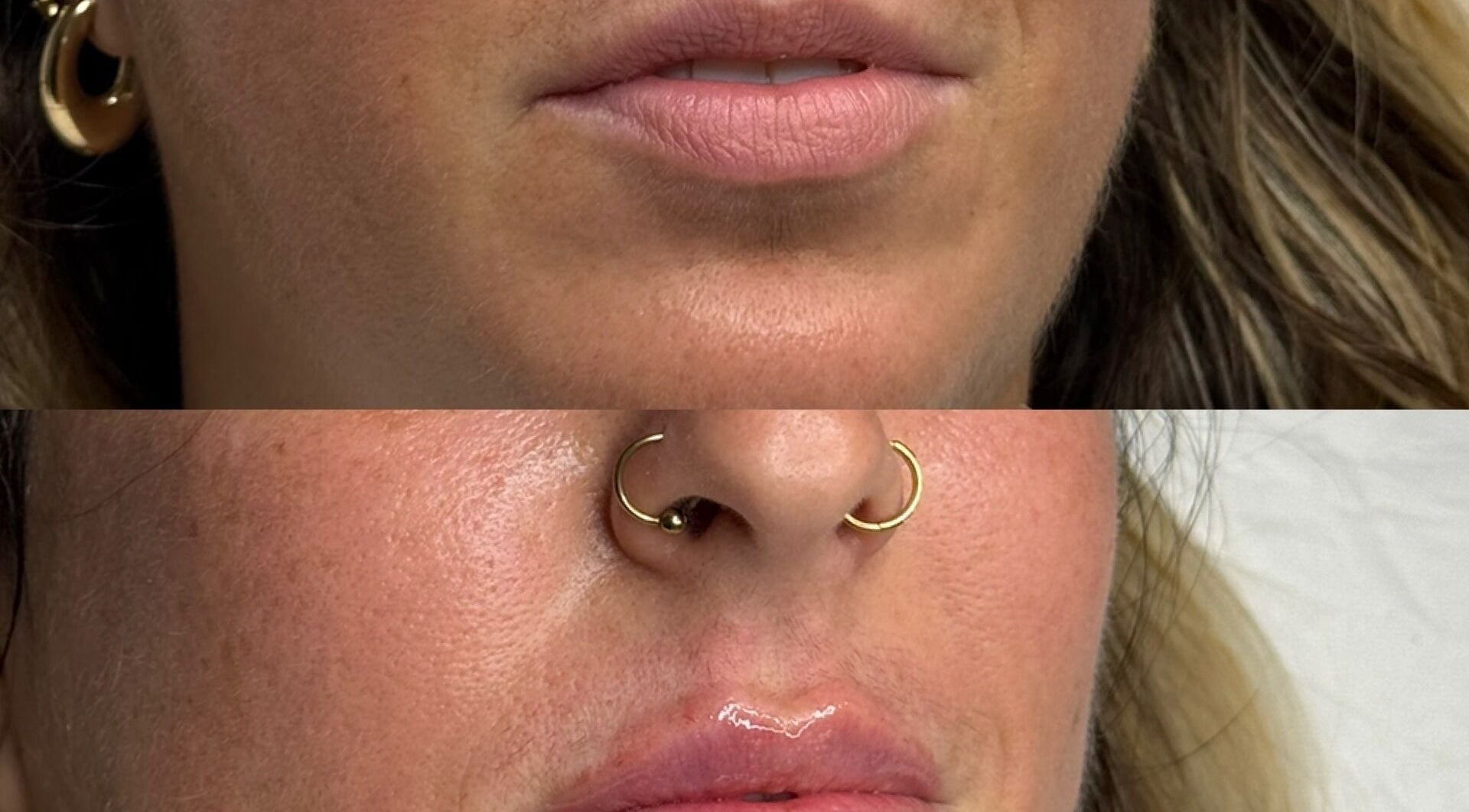 Lip enhancement at Reify Aesthetics, Chorley, England. Transformative results shown in before-and-after photos.
