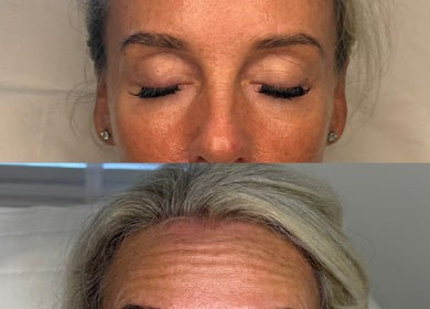 Before and after skin treatment at Reify Aesthetics, Chorley, England, GB, showing improved complexion.