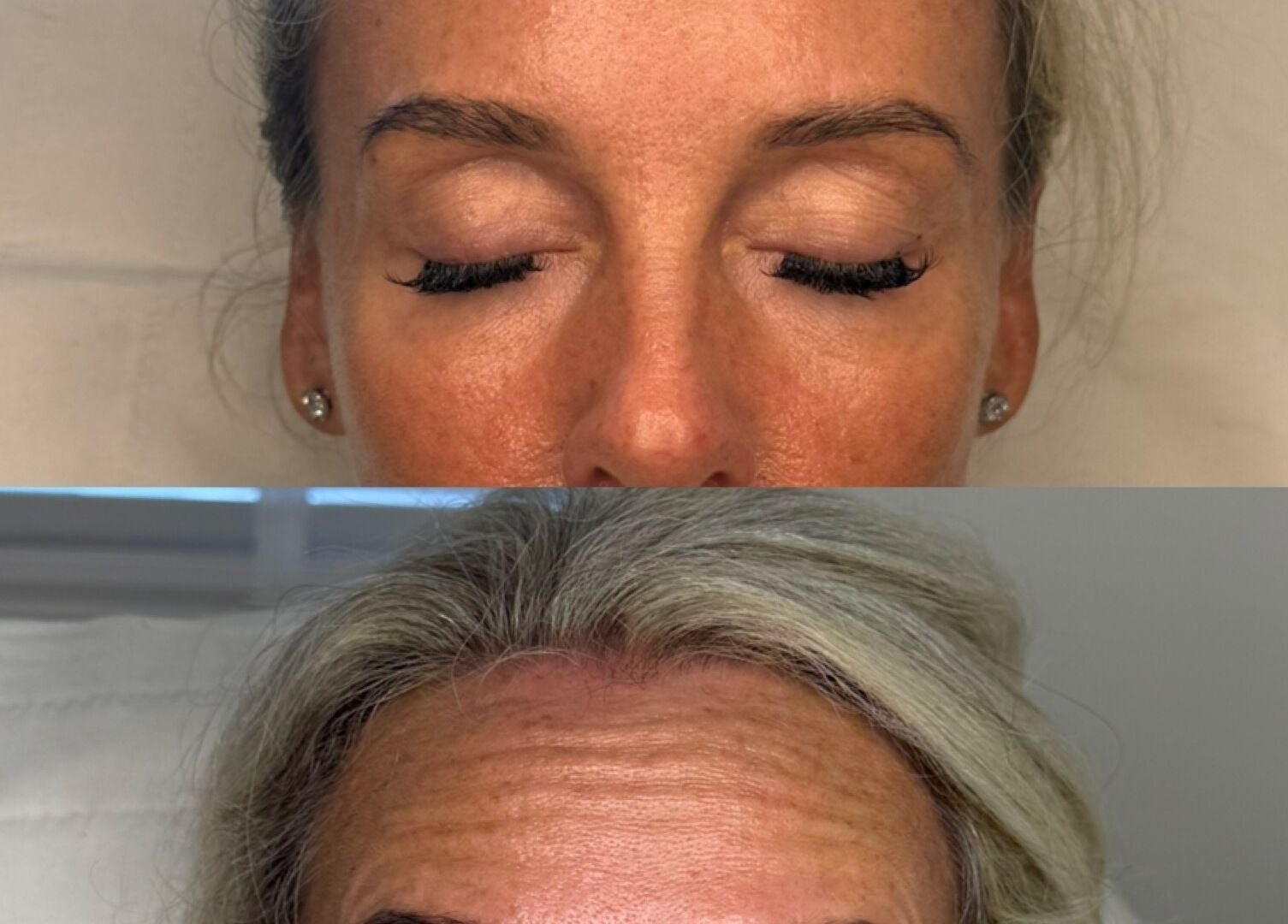 Before and after skin treatment at Reify Aesthetics, Chorley, England, GB, showing improved complexion.